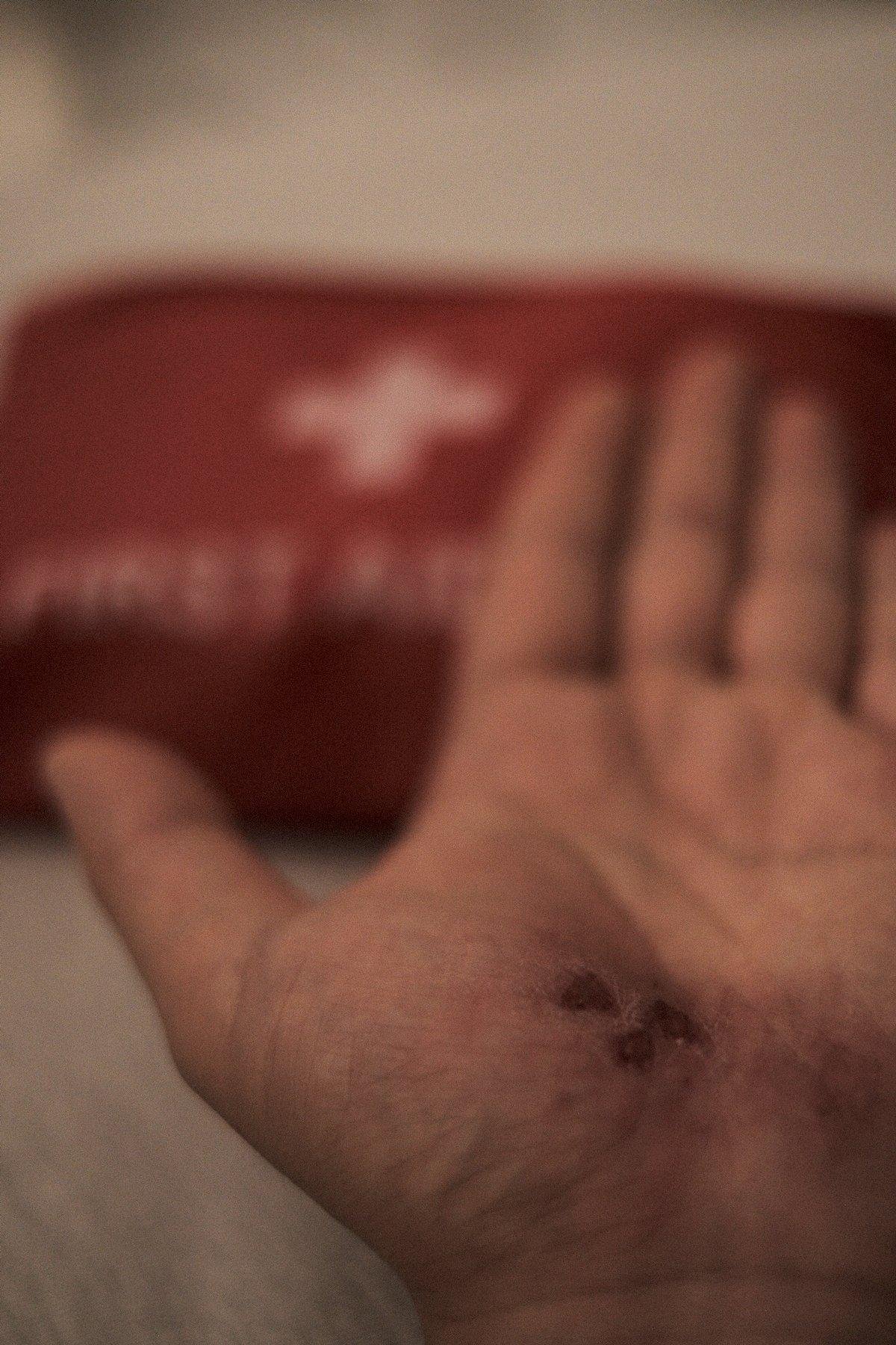 Photo verticale. Une main gauche, à plat, paume vers le haut avec une écorchure en 3 impacts en cours de cicatrisation. En arrière plan, une trousse rouge avec une croix blanche